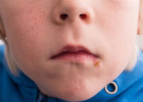 Impetigos bėrimų pavyzdžiai