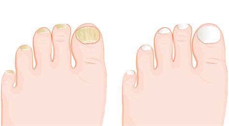 Nagų grybelio požymiai: pakitusi nago spalva ir sustorėjimas