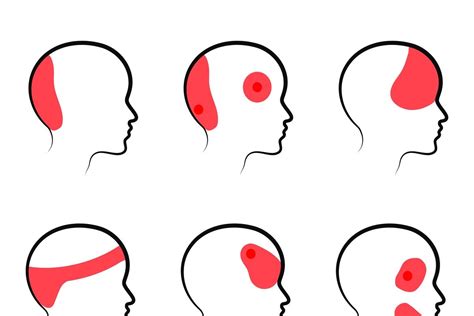 Skausmo žemėlapis pagal galvos sritis