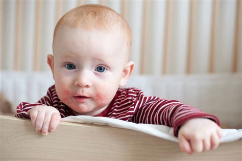simptomai kūdikių alergija pienui