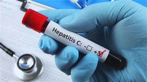 Hepatito C simptomų ir kepenų cirozės progresavimo diagrama