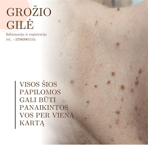 Lazerinis papilomų šalinimas