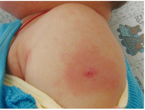 BCG skiepo vietos reakcija kūdikiui