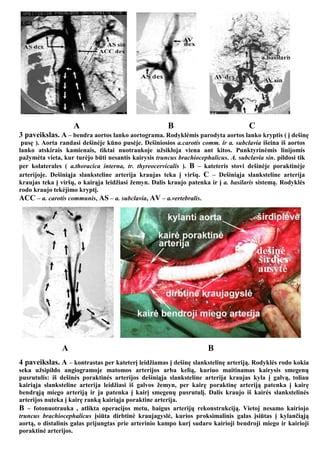 Aortos koarktacijos schema su implantuotu stentu