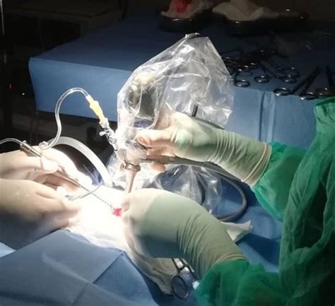 Chirurginės operacijos schema: rudimentinės uodegos pašalinimas