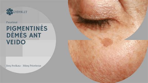 Pigmentinės dėmės ant odos