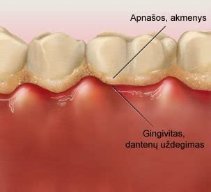 Periodontito progresavimas ir dantenų uždegimas