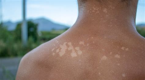 teisingas kremo nuo saulės tepimas ant vaiko odos