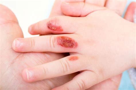 Dermatito paveikta vaiko ranka