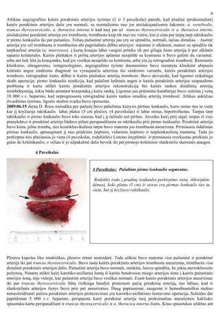Slankstelinės arterijos stento implantacija