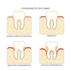 Periodontito pažeisti dantys