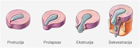 stuburo disko išvaržos schema