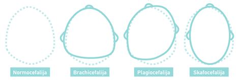 Kūdikių galvytės deformacijų tipai: Plagiocefalija, Brachicefalija, Skafocefalija