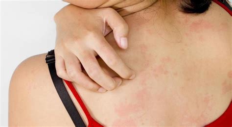 IgE ir ne IgE alerginės reakcijos į maistą