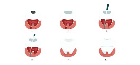 Dantų gydymo etapai nėštumo metu