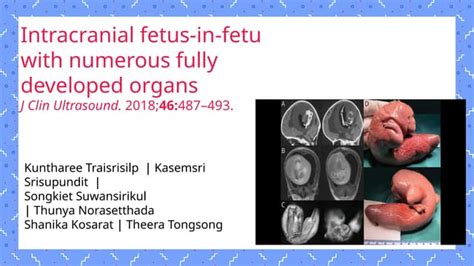Schematinis fetus in fetu iliustracija