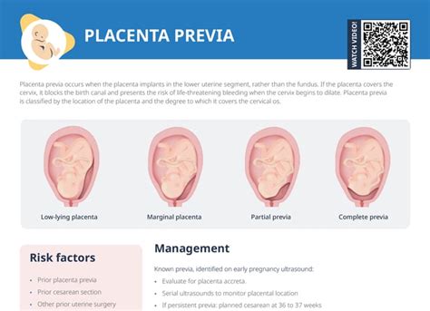 Placentos padėtys: normali ir placenta previa