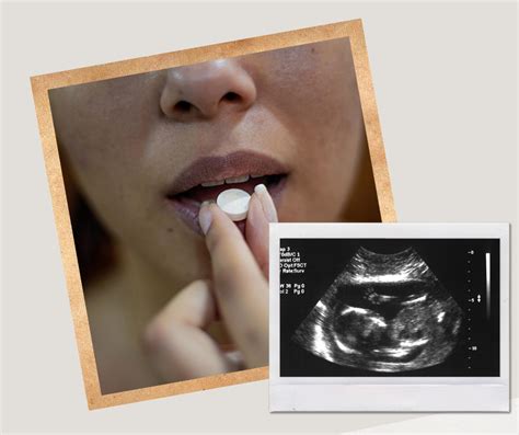 Medikamentinio aborto procedūros žingsniai