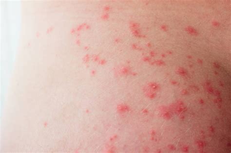 Odos strijos ant pilvo