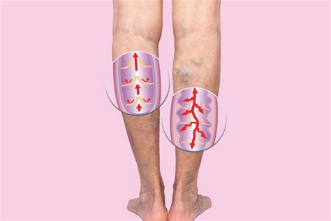 Išsiplėtusios venos ant kojos