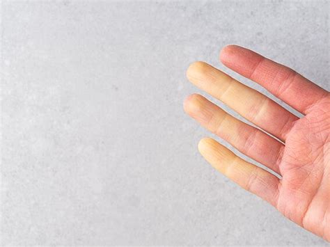 Dėmesio! Reino sindromas gali būti rimtos ligos požymis