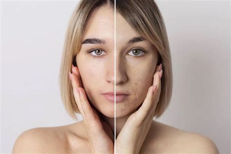 Nėštumo kaukė melasma ant veido