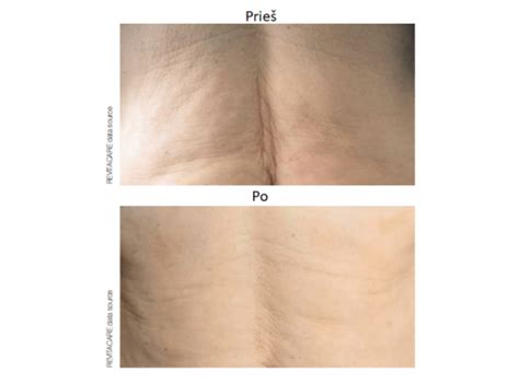 Odos elastingumo svarba strijų prevencijai