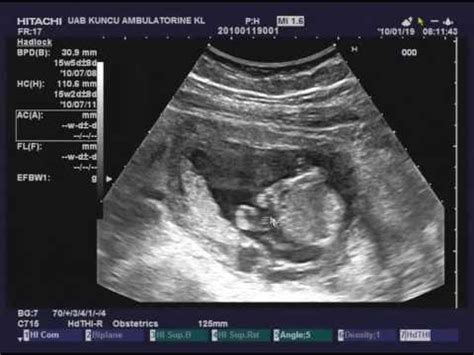 3D ultragarso nuotrauka, rodanti vaisiaus reakciją į prisilietimą