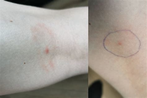 Odos alergijos testas ant riešo