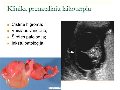 Vaisiaus sprando raukšlė ir cistinė higroma