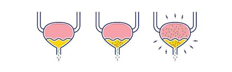 Šlapimo takų infekcijos sukėlėjai