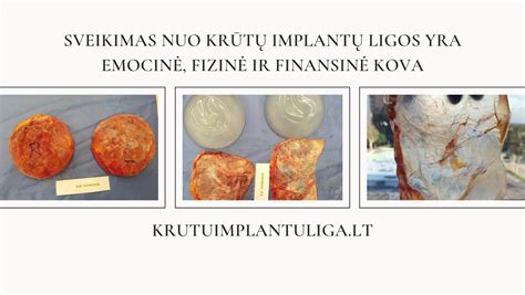Krūtų implantų pasirinkimo diagrama