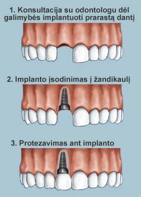 Dantų implantacijos procesas: nuo diagnostikos iki protezavimo