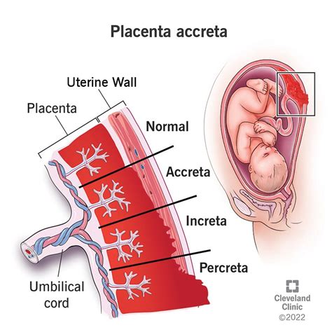 Placentos pirmeigos tipai