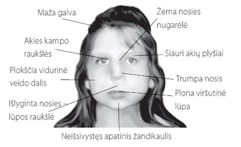 Vaisiaus alkoholinio sindromo (VAS) pažeisto vaiko veido bruožai