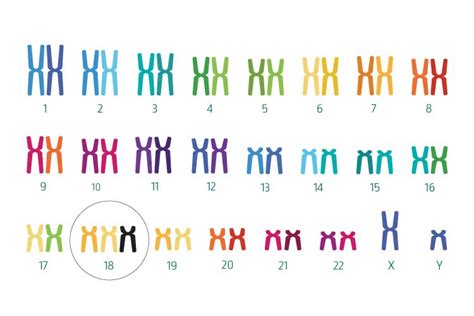 Chromosomų palyginimas: normali, trisomija 13, trisomija 18, trisomija 21