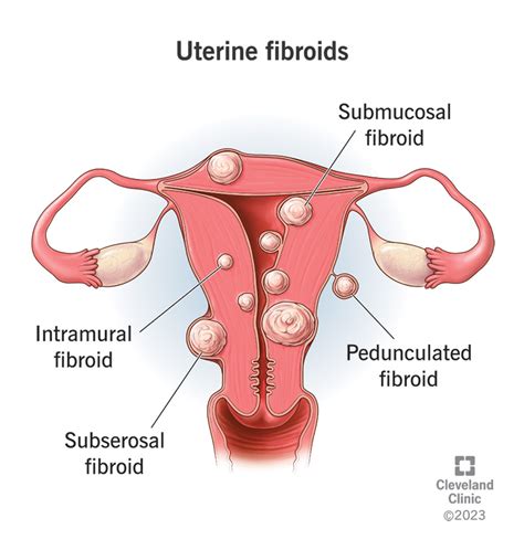 gimdos fibroma