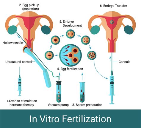 Apvaisinimo mėgintuvėlyje (IVF) proceso schema