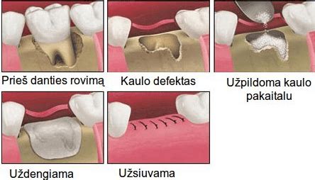 nuolatinio danties įtvaras