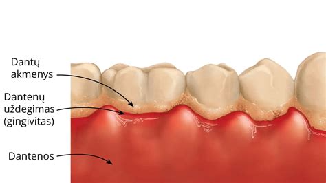 Schema, kaip apnašos sukelia dantų problemas