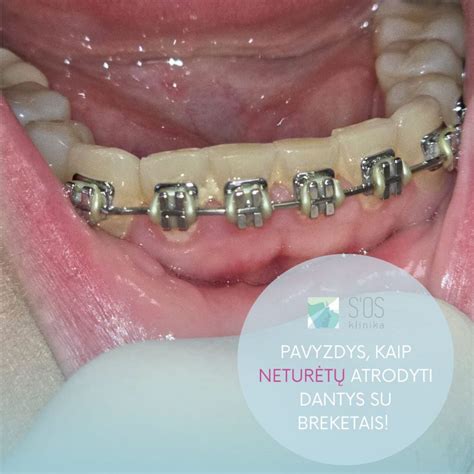 Nuotrauka su breketais ir pavyzdžiu, kaip juos valyti