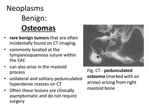 Osteomos schema kaukolėje