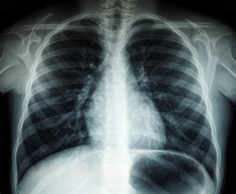 Plaučių rentgeno nuotrauka