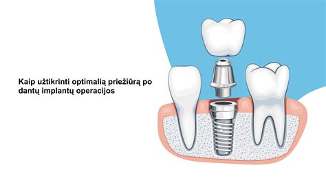 Dantų implantų schema