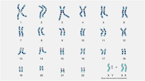 Schematinis žmogaus kariotipo vaizdas su Ternerio sindromo chromosomomis