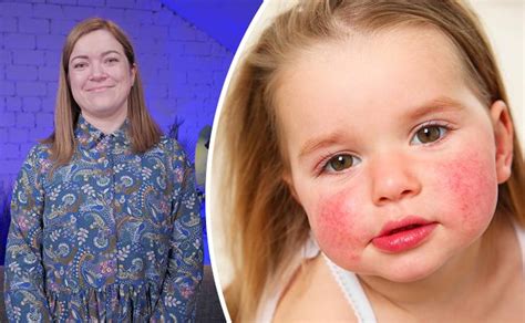 Schema: Alergijos darželyje - tėvų ir įstaigos atsakomybės