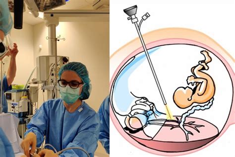 Dvynių transfuzijos sindromas schema