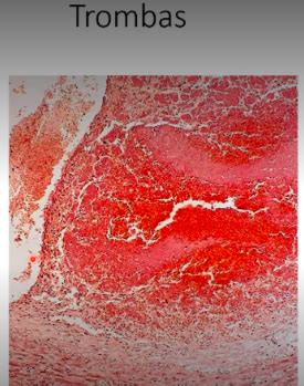 vaisiaus vandenų embolija