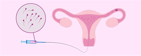Schema, kaip atliekama intrauterininė inseminacija