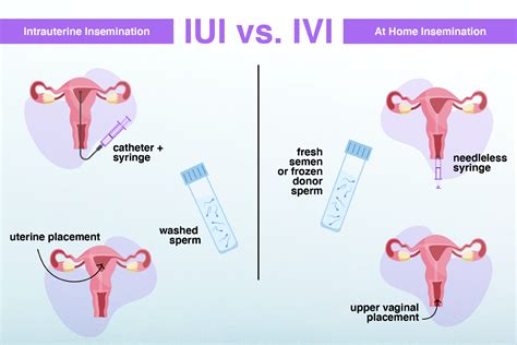 Schema, palyginanti IUI ir IVF procedūras